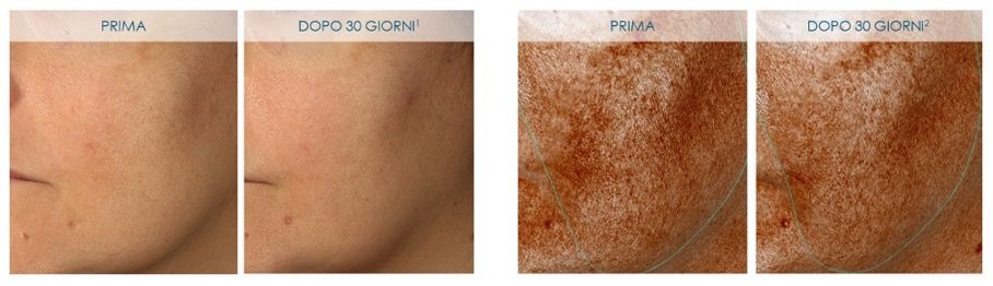 Comparaison avant-après de taches pigmentaires du visage